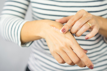 A woman applying scar removal cream to healed the cooking oil burn scar on a her hands. Healing, Removal, Hot oil burn treatment, Vitamin E, Scars care, Skin care products, Medical cream.