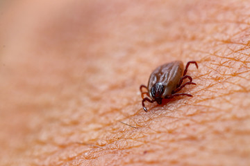 Tick filled with blood sitting on human skin.