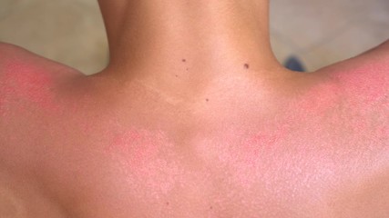 Sunburn is the result of too much exposure to the sun, or a sun-equivalent (such as a tanning bed or other UV source). Severe sunburn symptoms: redness, pain, skin peeling, skin burning and blistering