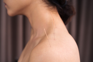 woman undergoing acupuncture treatment on shoulder