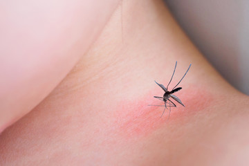 little asian girl skin rash and allergy with red spot cause by mosquito bite