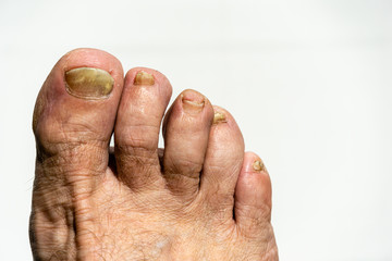 Fungus on toenail plate. Fungus on toenails. Nail plate is affected by fungus. Toenails destroyed...