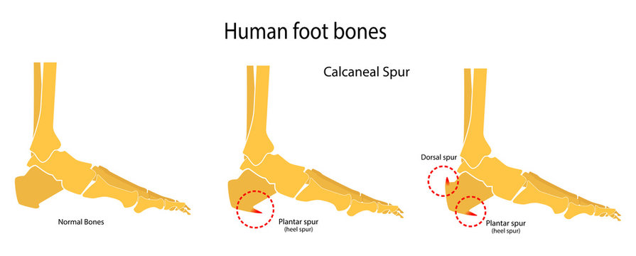 Calcaneal Spur