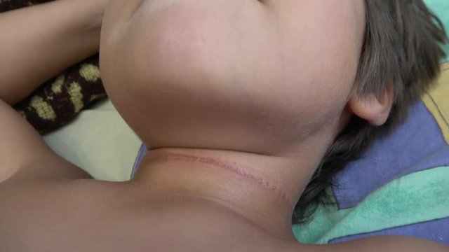 4K Kid with a sore mark on his neck after accident, crystal child