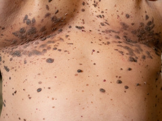 close-up many large big brown nevus on human chest skin body