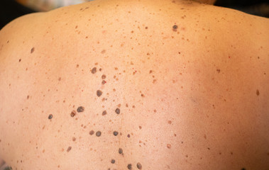 woman patient on clinical trials with lot on brown nevus on body back - obrazy, fototapety, plakaty