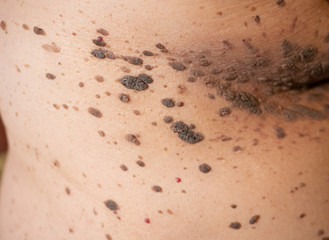 closeup of large brown nevus moles on human body skin