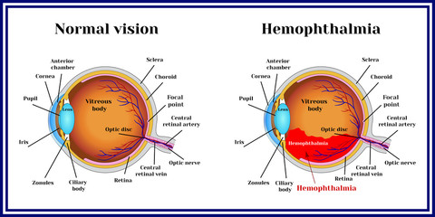 Hemophthalmia