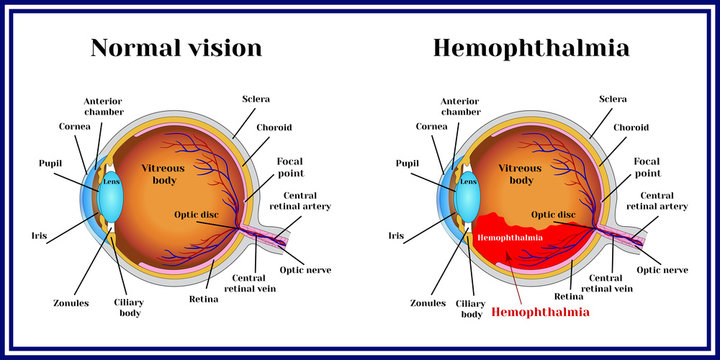 Hemophthalmia