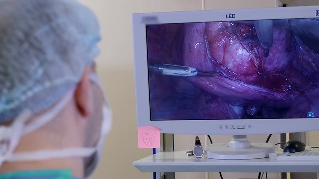 Surgeon looks at display and performs a laparoscopic operation to remove uterine fibroids