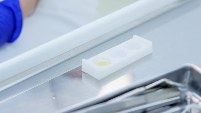 Dentist prepares fluoride for fluoridation pfocedure of teeth after ultrasonic cleaning, hands closeup. Dental hygienist cares about patient's teeth. Treatment cure teeth in stomatology clinic.