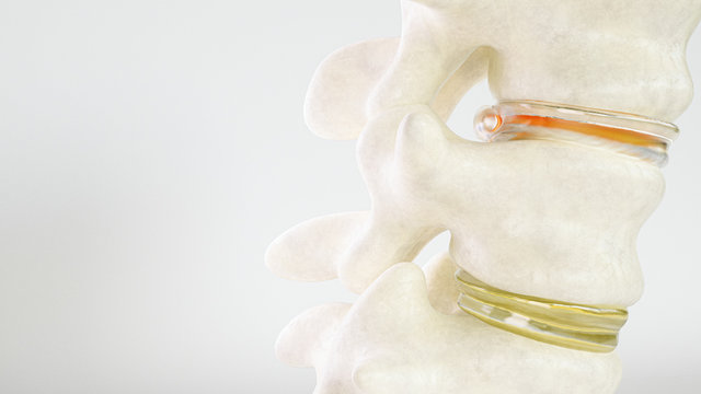 Spinal disc herniation as close-up as 3D Rendering