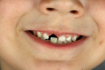 boca de niño feliz que ha perdido un diente de leche