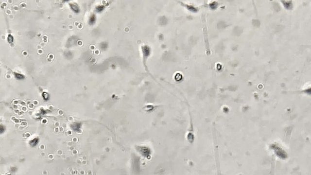 View at human sperm under microscope in lab