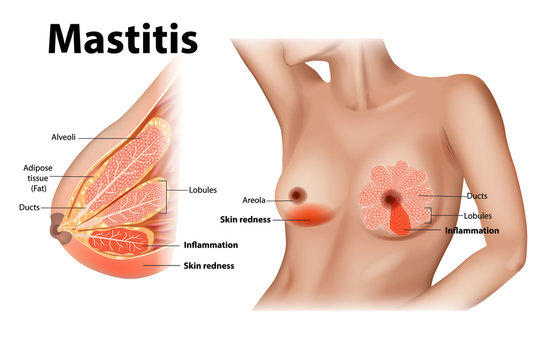 Mastitis is inflammation of the breast