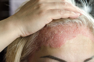 Dermatological skin disease. psoriasis, eczema, dermatitis, allergies. Skin lesions on the head.