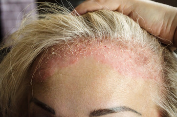 Dermatological skin disease. psoriasis, eczema, dermatitis, allergies. Skin lesions on the head.