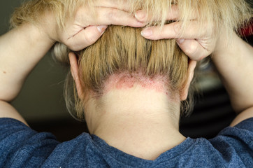 Dermatological skin disease. psoriasis, eczema, dermatitis, allergies. Skin lesions on the head.