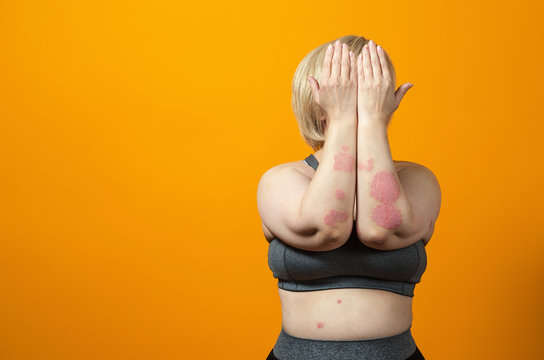Dermatological skin disease. psoriasis, eczema, dermatitis, allergies. Skin lesions on the elbows.