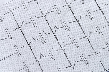 心電図レポート