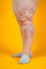 Dermatological skin disease. psoriasis, eczema, dermatitis, allergies. Skin lesions on the legs.