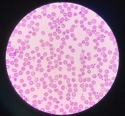 Blood smear show platelet increase.