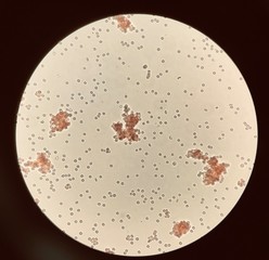 Red blood cells agglutination in crossmatching test incompatible reation.