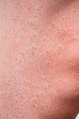 カミソリ負けして赤くなった男性の脚