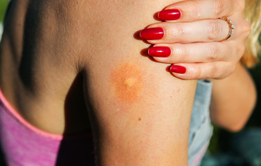 Mosquito bite on the shoulder. Insects in the summer. Dangerous nature. Itchy arm.