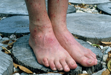 Man with Chigger bites, Costa Rica, (Eutrombicula sp), Trombiculidae family, infestation on feet.