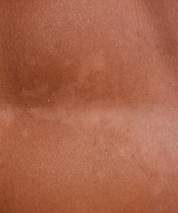 Fototapeta premium Sunburn on the skin of the stomach. Exfoliation, skin peels off. Dangerous sun tan