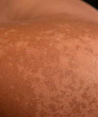 Fototapeta premium Sunburn on the skin of the shoulders. Exfoliation, skin peels off. Dangerous sun tan