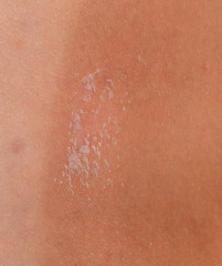 Fototapeta premium Sunburn on the skin of the back. Exfoliation, skin peels off. Dangerous sun tan