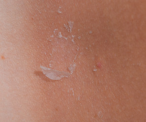 Fototapeta premium Sunburn on the skin of the back. Exfoliation, skin peels off. Dangerous sun tan