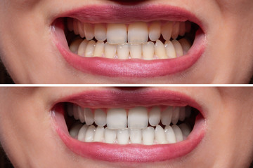 Person Teeth Before And After Whitening