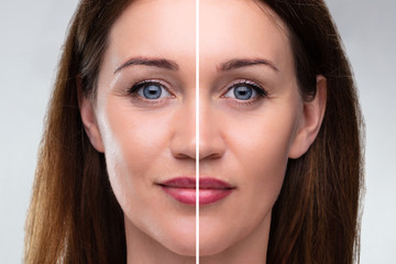 Woman's Face Before And After Cosmetic Procedure