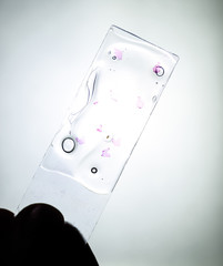 Slices of the tumor under glass. Histological examination of tumor cells for the presence of cancer