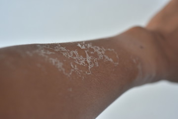 Arm dry skin peeling after sun burned