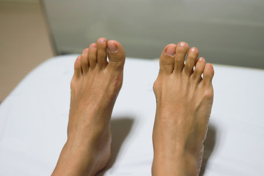  Hallux Valgus in an Asian girl before and after Proximal phalanx osteotomies. Left feet is after surgery and Right feet is befor surgery.