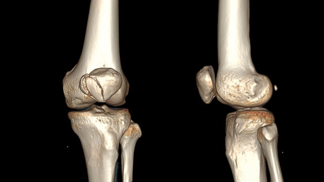 CT SCAN 3D of right knee in AP & lateral position. Fracture patella