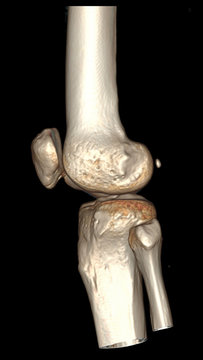 CT SCAN 3D of right knee in lateral position. Fracture patella