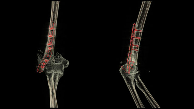3D computed tomography (CT) of elbow with transparent bone ,metallic enhance in anteroposterior & lateral position