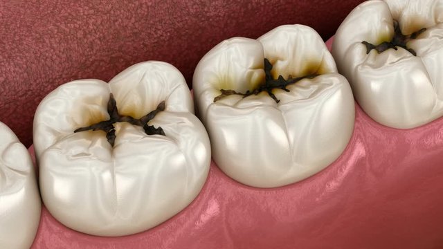 Molar teeth damaged by caries. Medically accurate tooth 3D animation