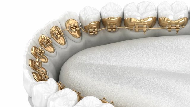 Lingual braces system. 3D animation concept of golden braces