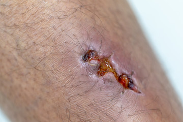 Closeup injured at leg, Fresh wounds from accident. 