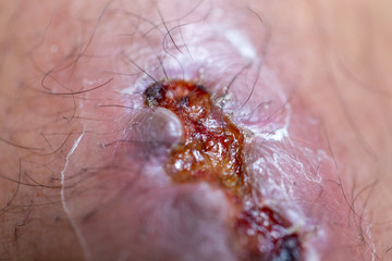 Closeup injured at leg, Fresh wounds from accident. 