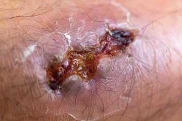 Closeup injured at leg, Fresh wounds from accident. 