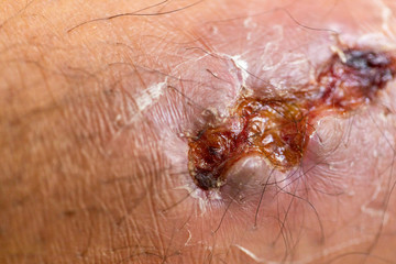 Closeup injured at leg, Fresh wounds from accident. 