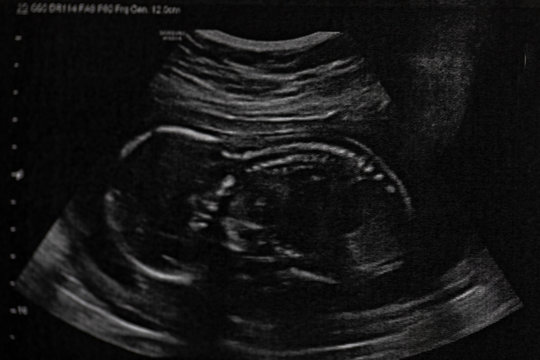 Ultrasound of baby in pregnant woman, Doctor reading test results of pregnant woman by ultrasound.