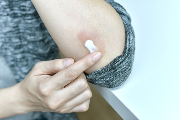 Skin allergy diseases problem, Close up of treatment on atopic dermatitis rash, Female dermatology...